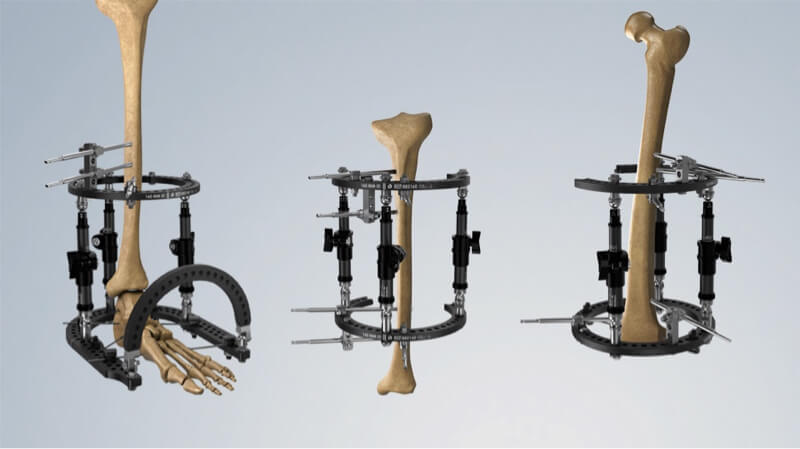 TrueLok EVO Ring Fixation System